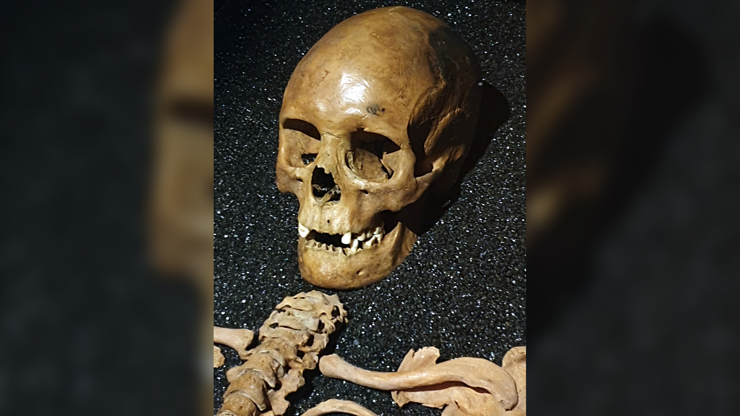 foto tengkorak, tulang belakang atas dan tulang selangka G