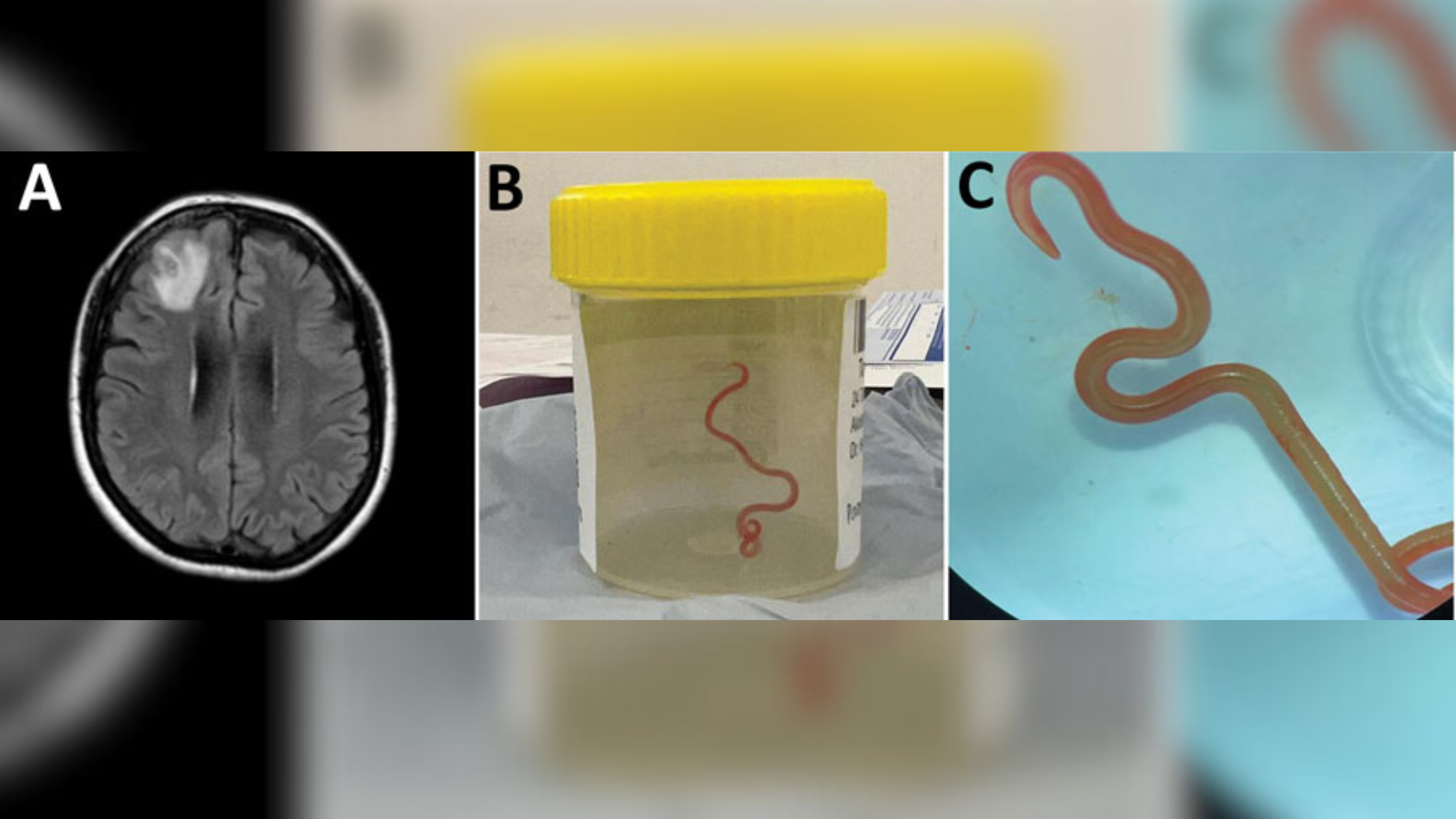 Gambar dari kertas yang menunjukkan pemindaian MRI dari lesi di otak wanita di sebelah kiri dan dua gambar cacing yang diekstraksi di sebelah kanan